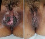 Transgender Vagina Surgery Before And After CLOUDY GIRL PICS